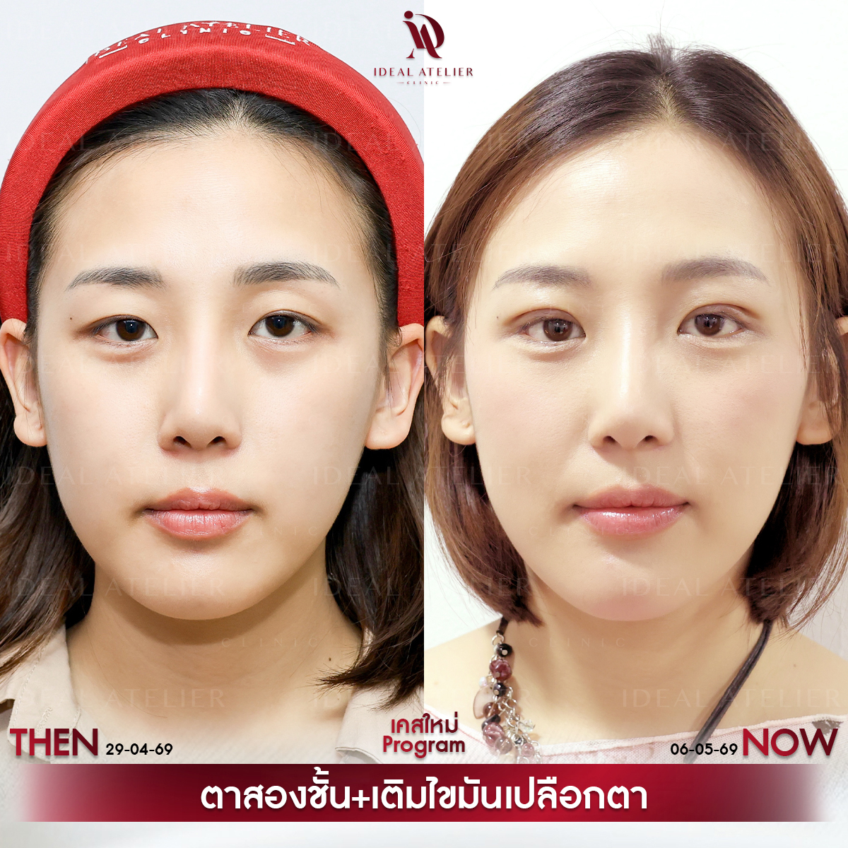 A-01-นิ้ง