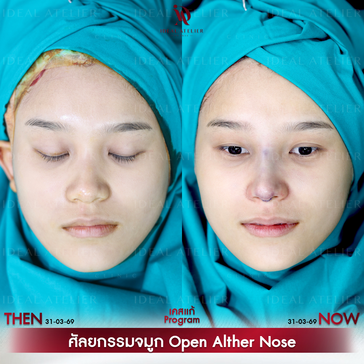 A-01-แก้ม