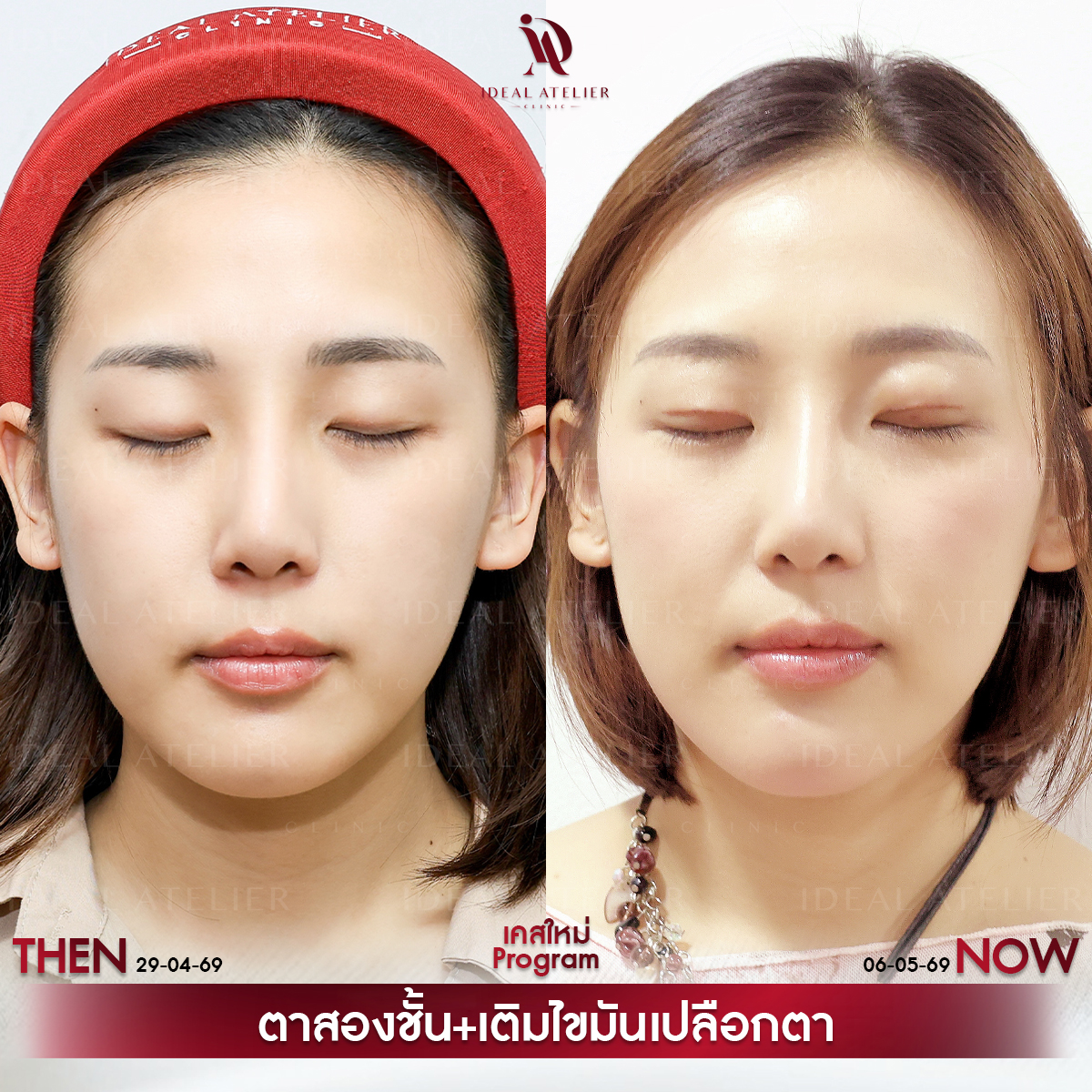 A-02-นิ้ง