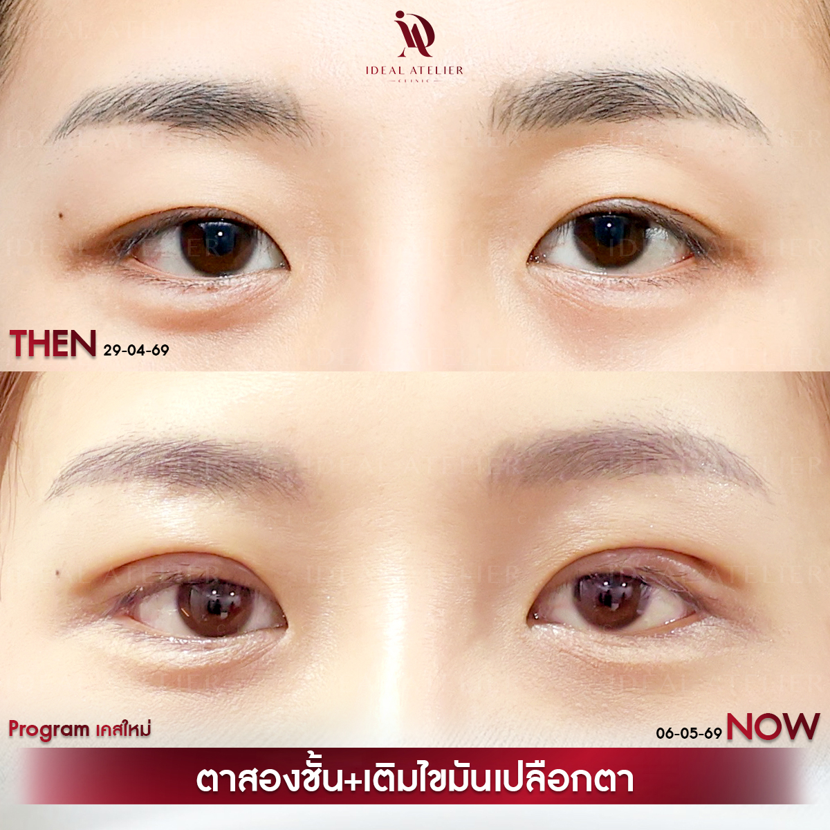 A-03-นิ้ง