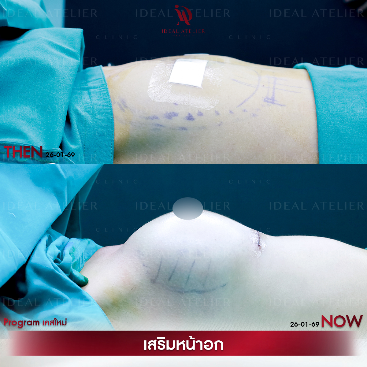 A-03-เฟิร์น