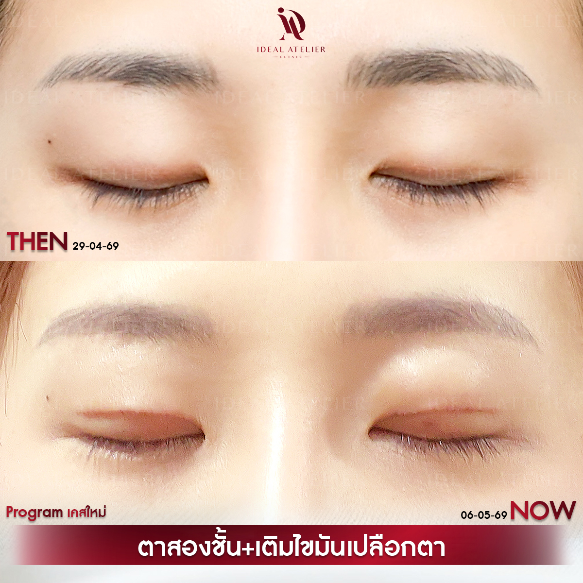 A-04-นิ้ง