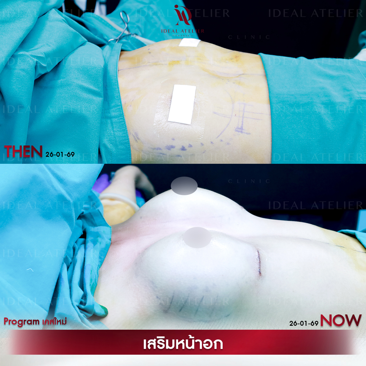 A-04-เฟิร์น