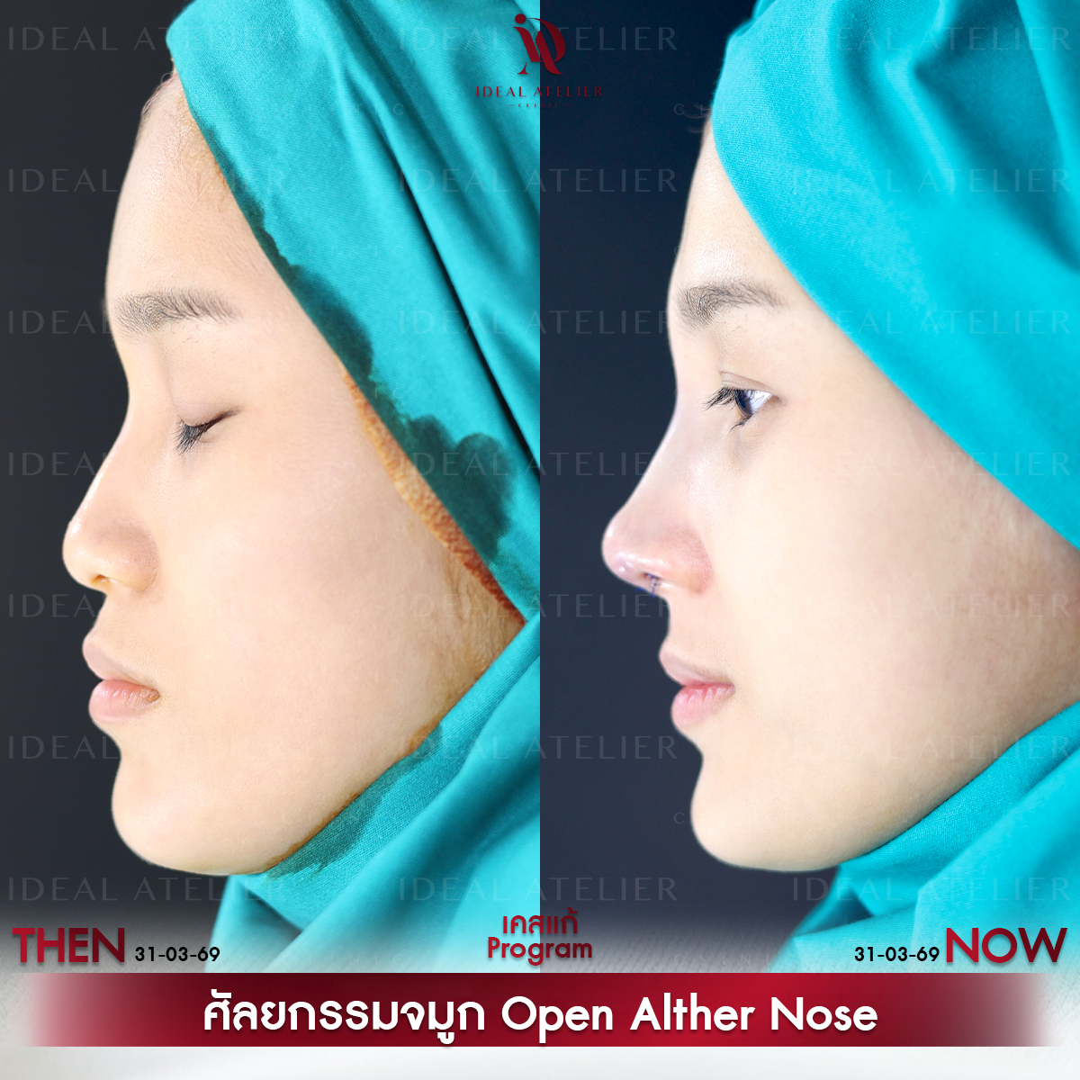 A-04-แก้ม