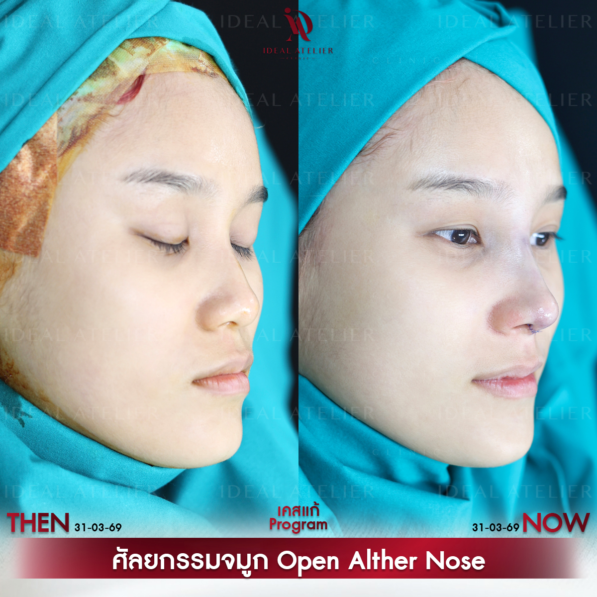 A-05-แก้ม