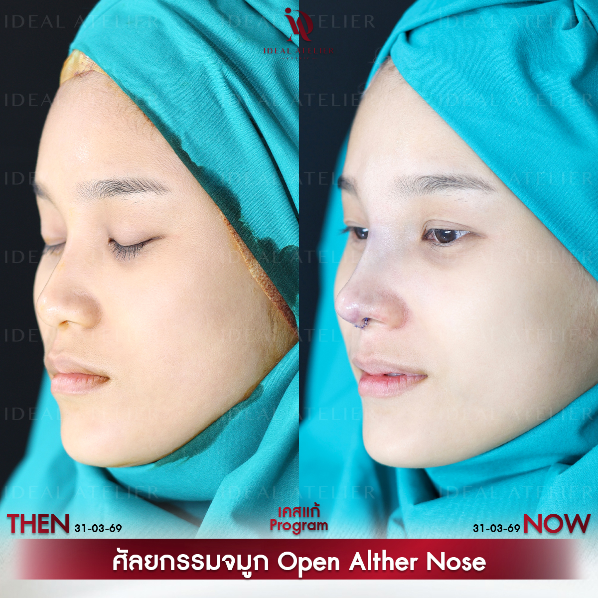 A-06-แก้ม
