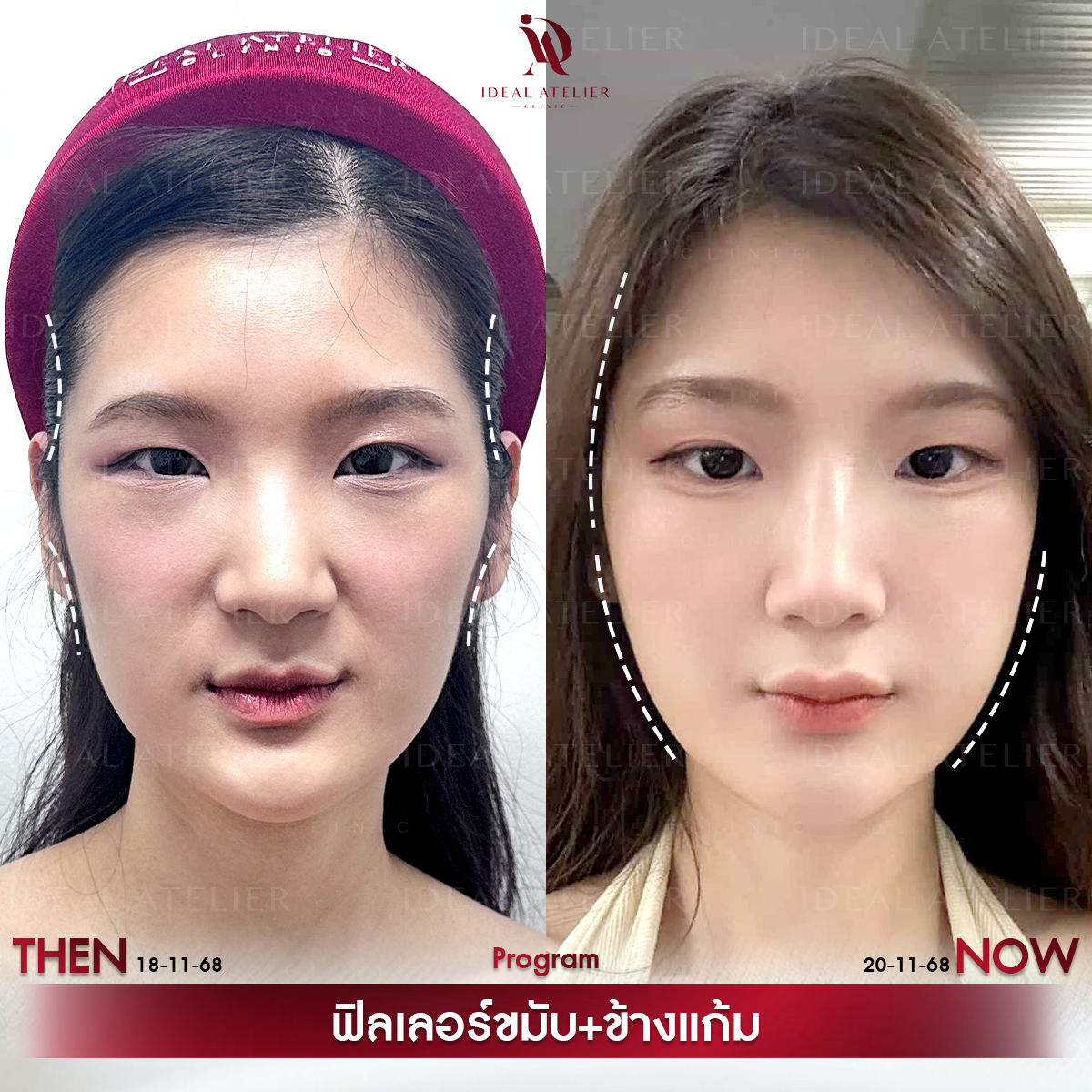 A-แก้ม
