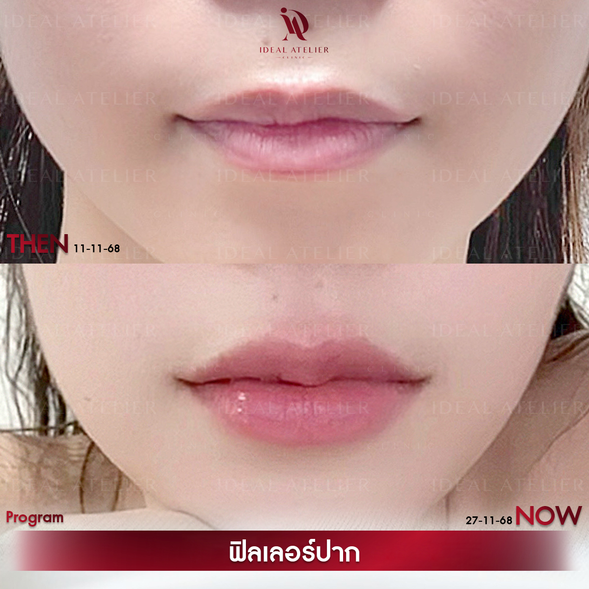 A-ไอซ์