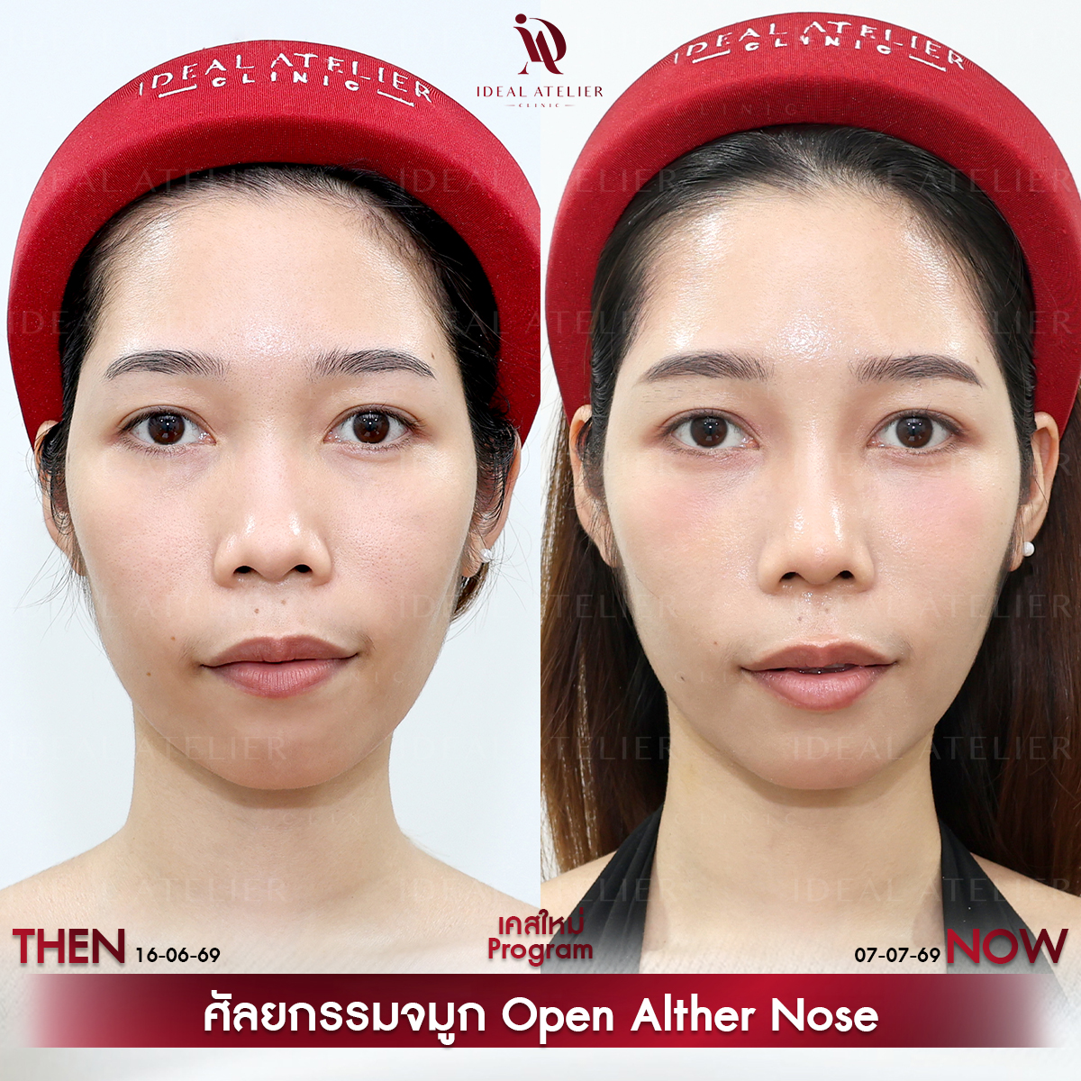 B-09-ไอซ์