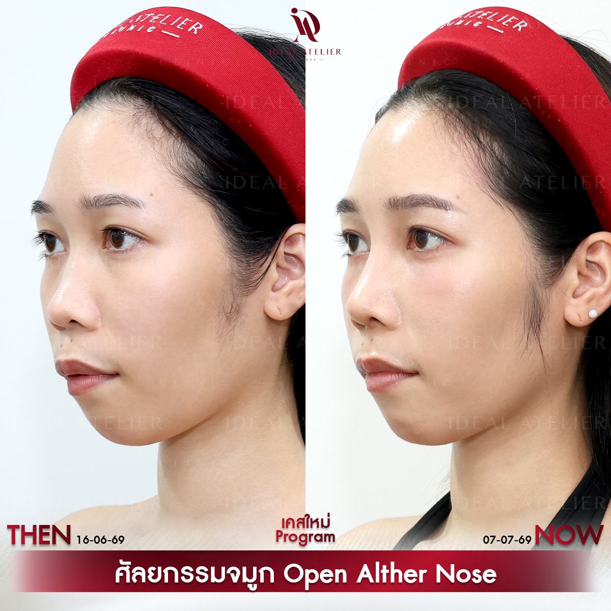 B-12-ไอซ์
