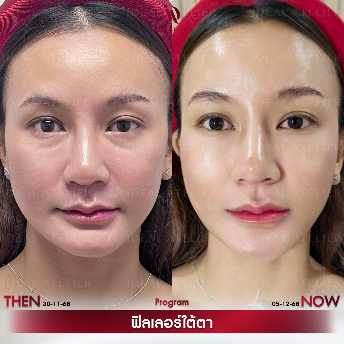 B-เชอร์