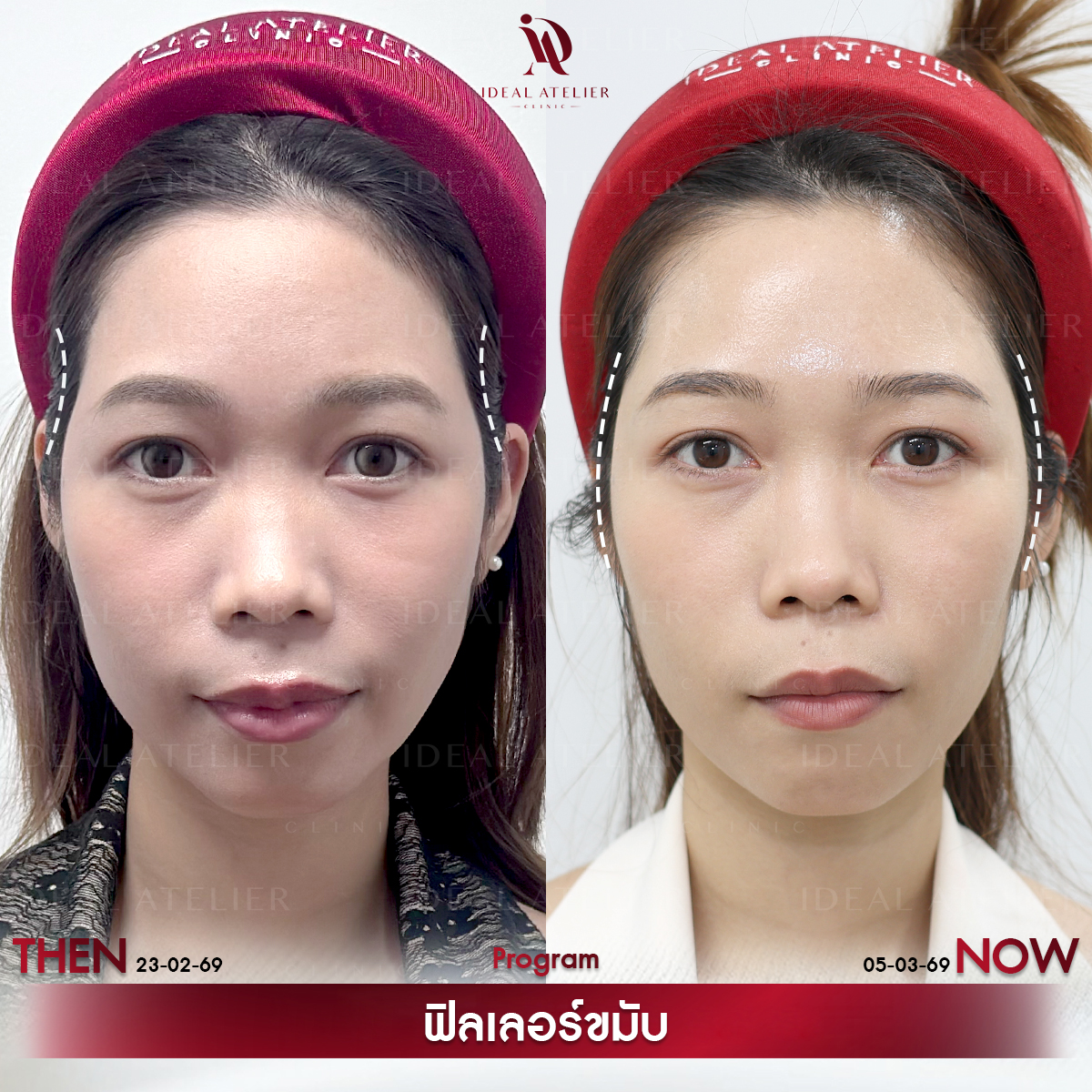 B-ไอซ์