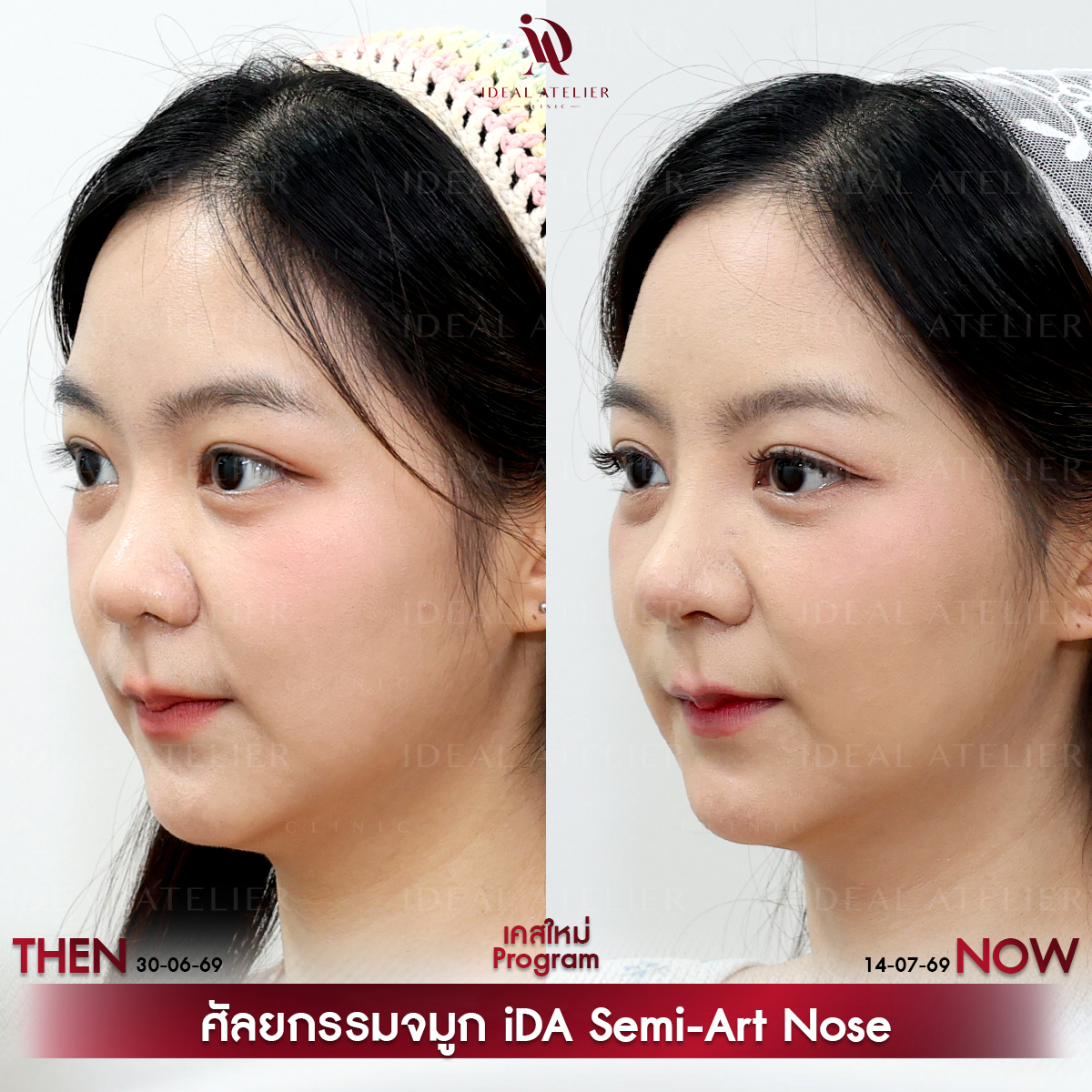 D-10-พีช