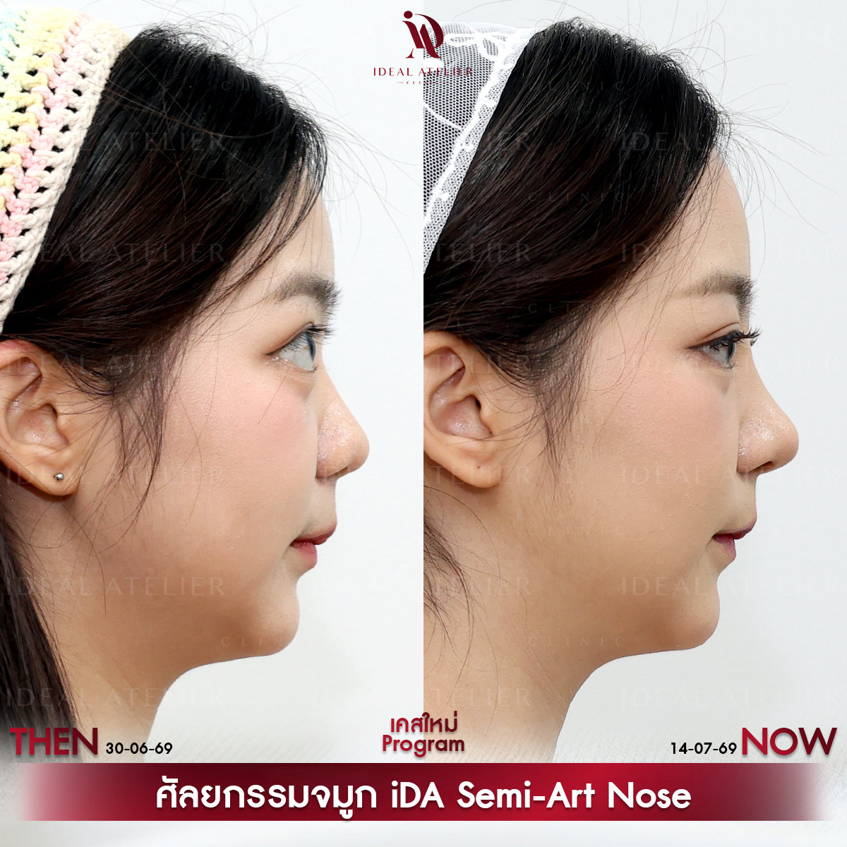 D-11-พีช