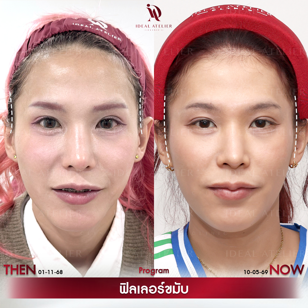 D-พินเนอร์