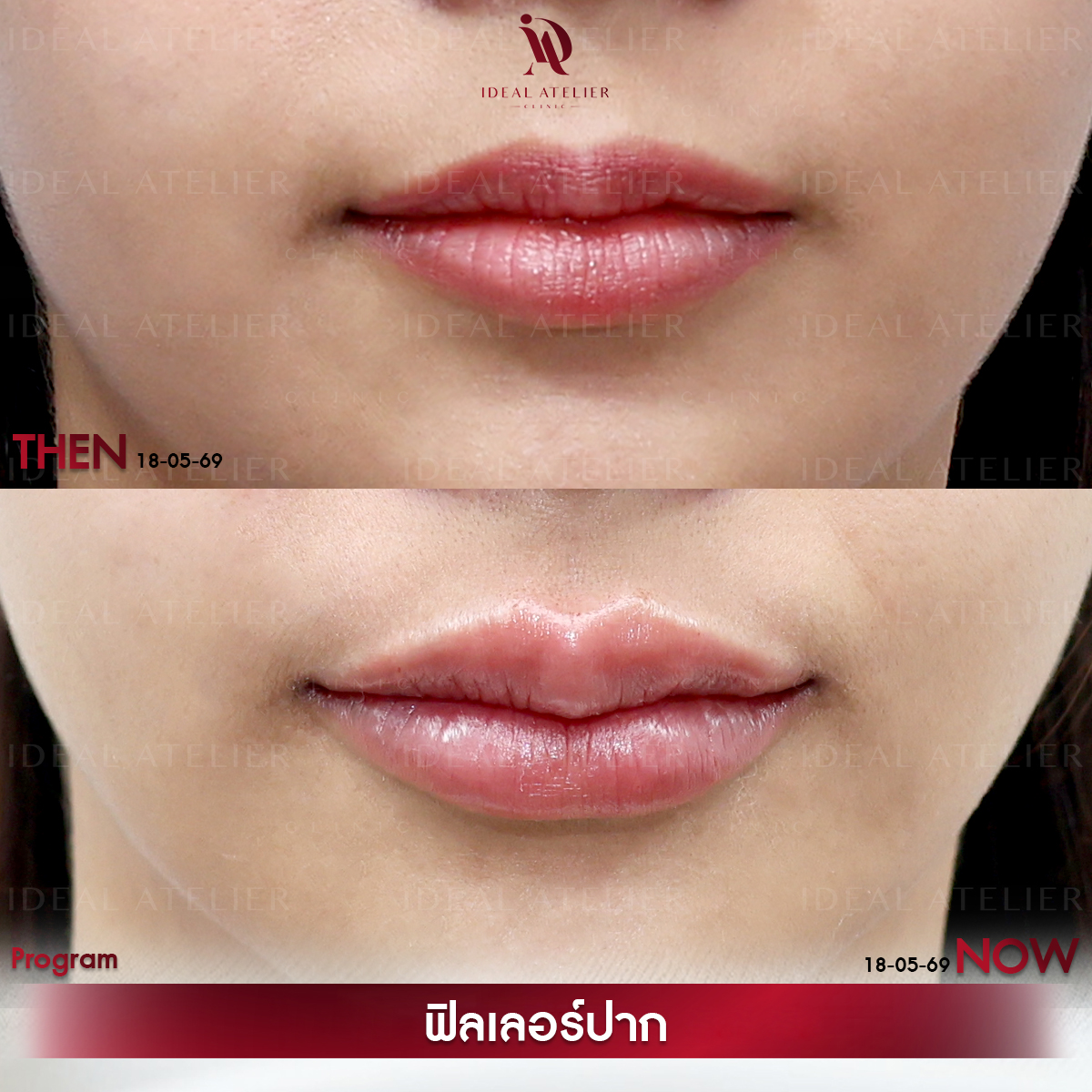 D-อ้อน