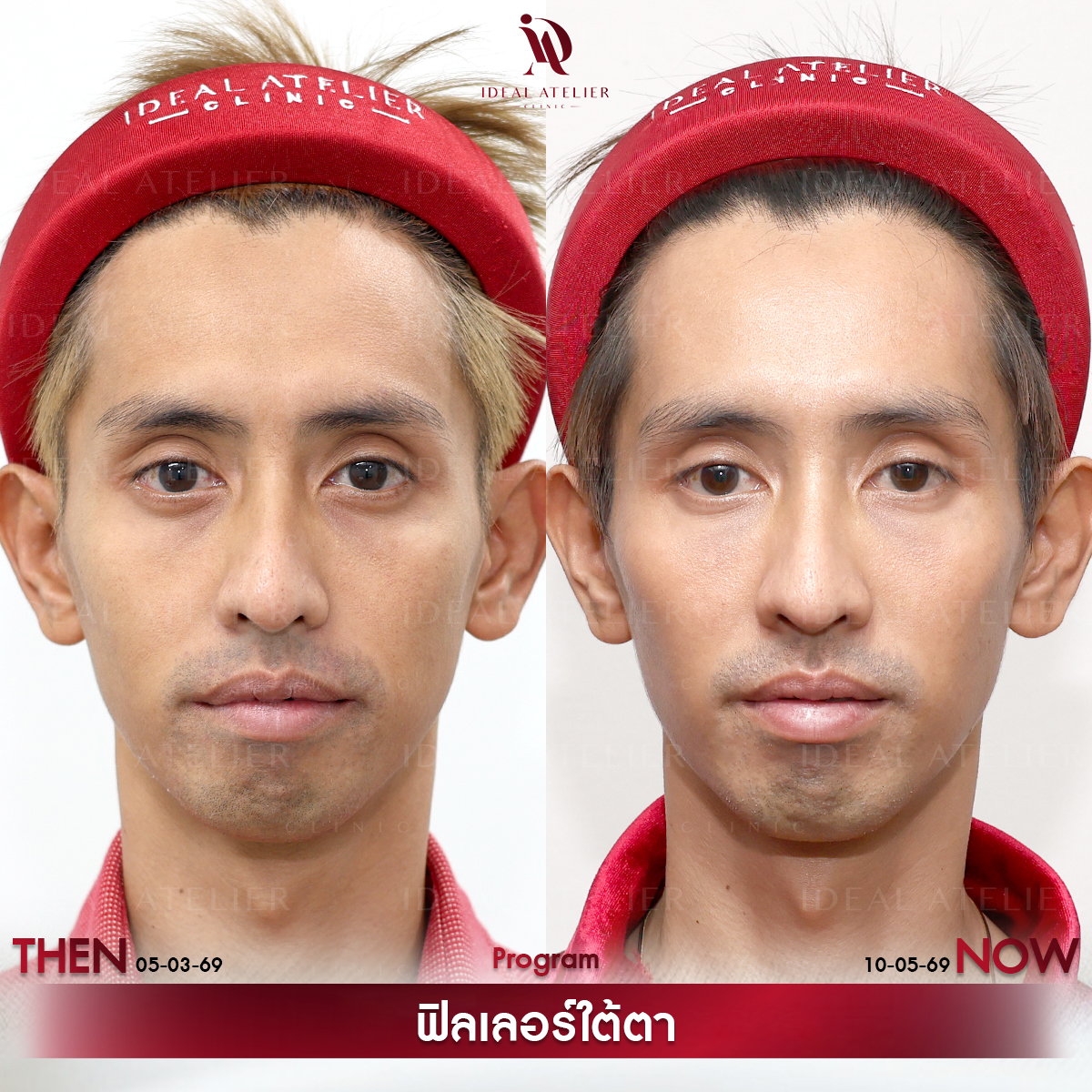 D-เดียว
