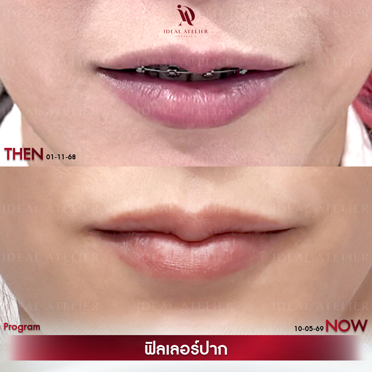 E-พินเนอร์