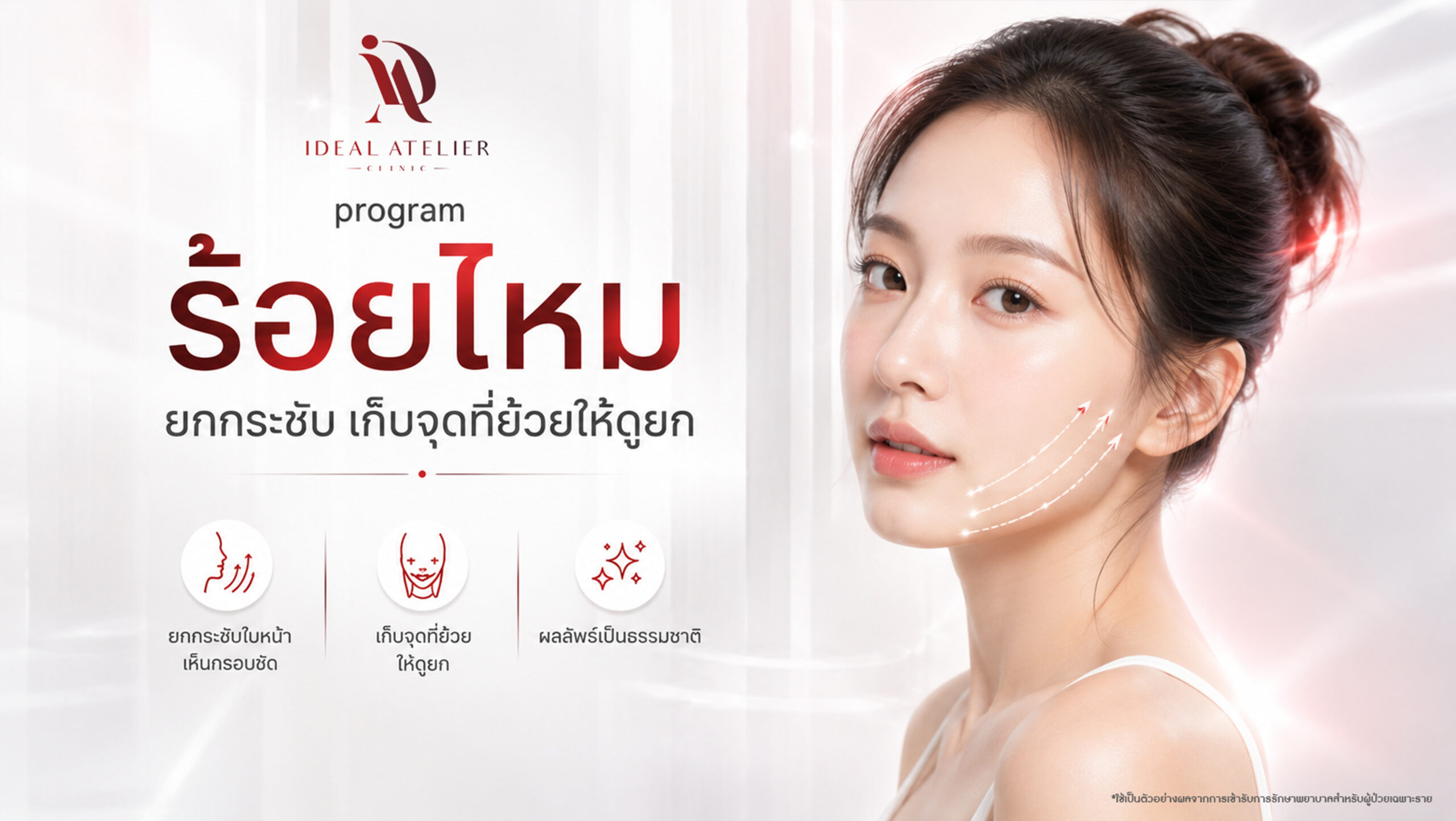 ร้อยไหม (Thread Lift)