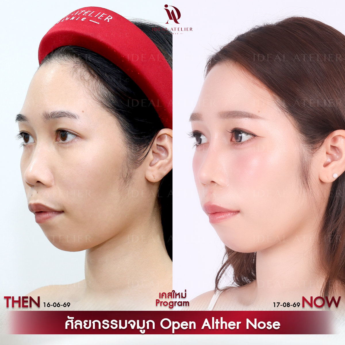 B-12-ไอซ์